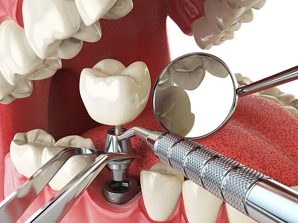 Best Urgent Tooth Repair  in Pepperdine University, CA